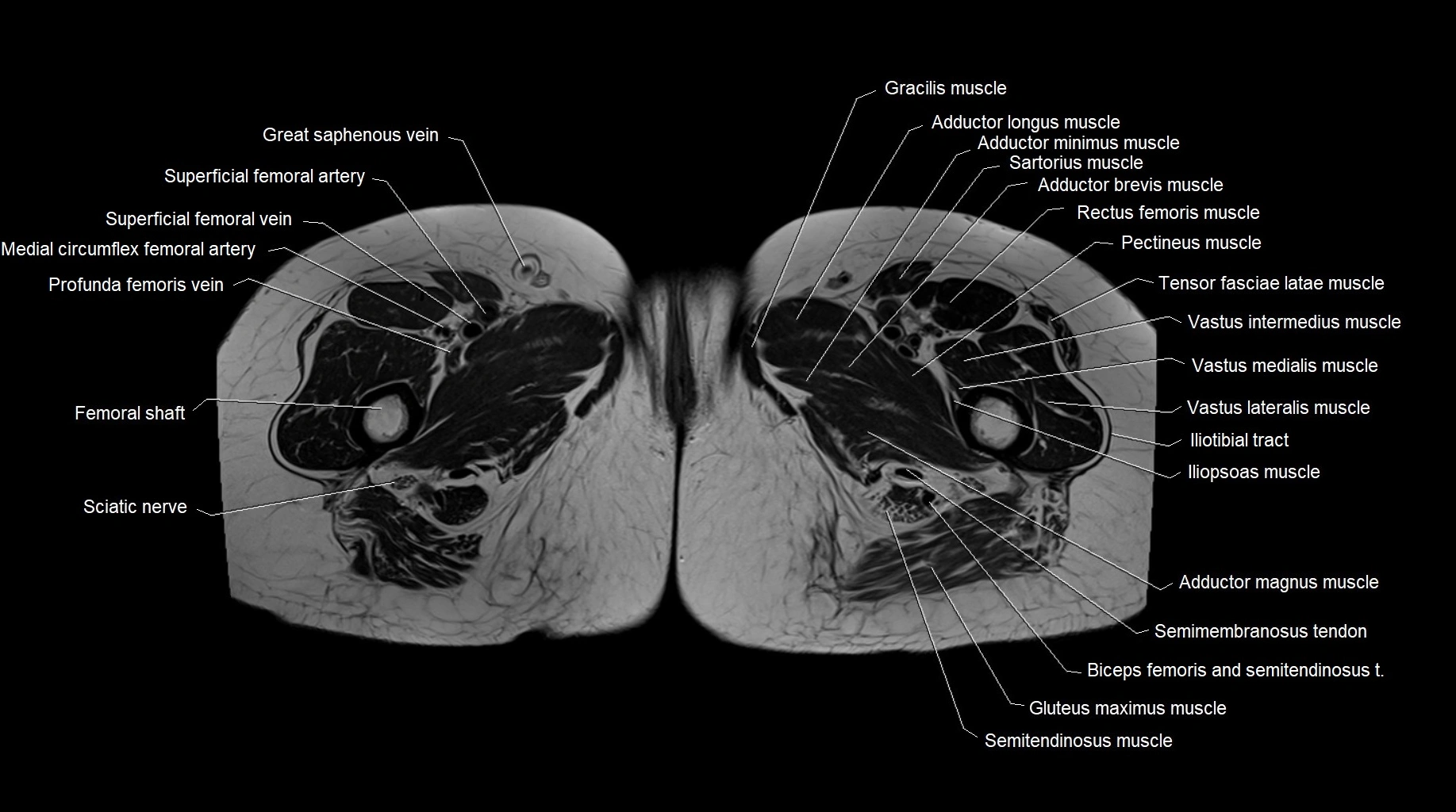 MRI 3T pelvis axial cross section anatomy image 36.webp